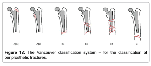 Understanding, Interpreting and Reporting a Total Hip ...