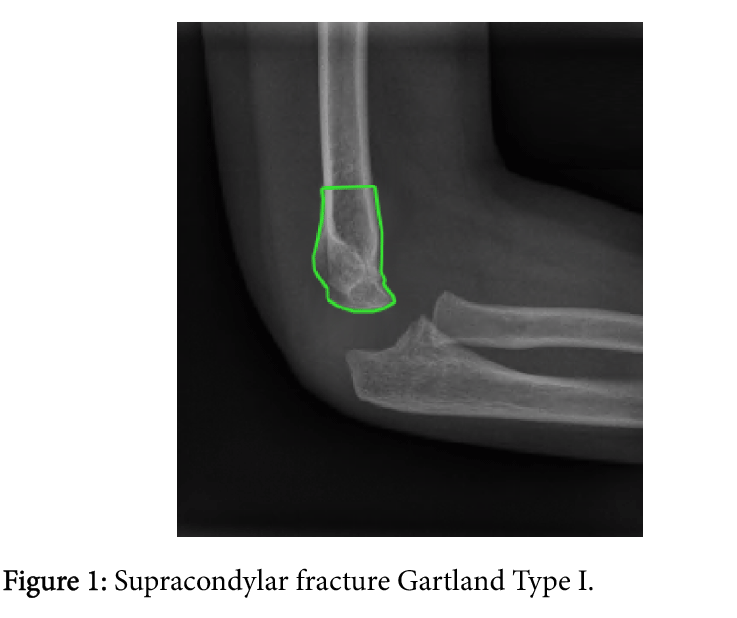 grading supracondylar fracture