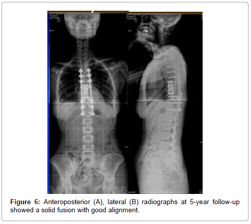 orthopedic-oncology-Anteroposterior-lateral-radiographs-alignment