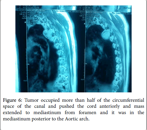 orthopedic-oncology-Aortic-arch