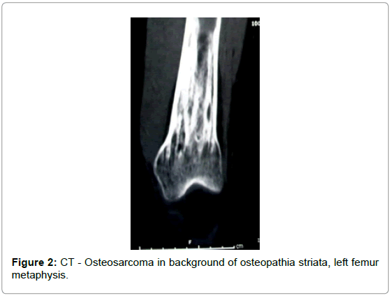 orthopedic-oncology-CT-Osteosarcoma-left-femur-metaphysis