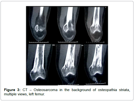 orthopedic-oncology-CT-Osteosarcoma-multiple-views