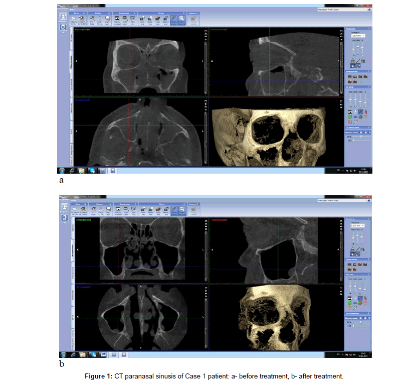 orthopedic-oncology-CT-paranasal