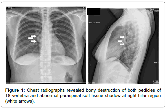 orthopedic-oncology-Chest-radiographs-revealed-bony