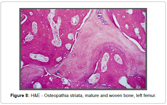 orthopedic-oncology-Osteopathia-striata-mature-woven-bone