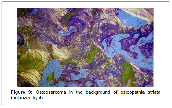 orthopedic-oncology-Osteosarcoma-background-osteopathia-striata