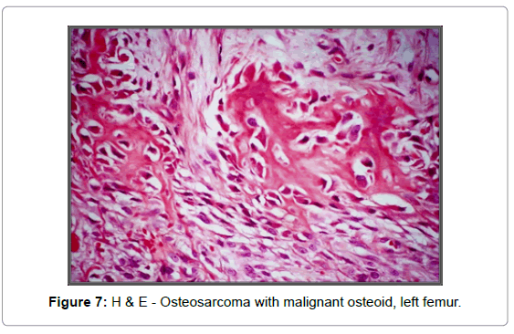 orthopedic-oncology-Osteosarcoma-with-malignant-osteoid