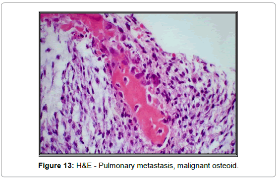 orthopedic-oncology-Pulmonary-metastasis-malignant-osteoid