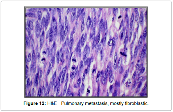 orthopedic-oncology-Pulmonary-metastasis-mostly-fibroblastic
