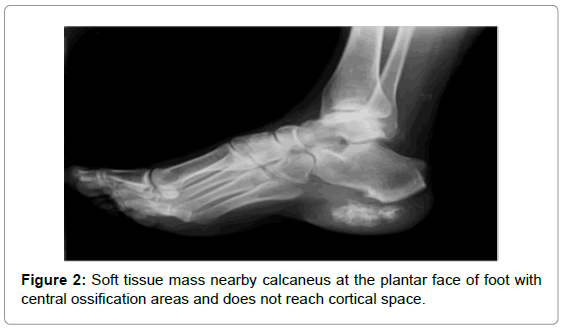 orthopedic-oncology-Soft-tissue-mass-nearby-calcaneus