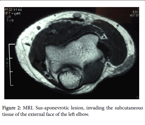 orthopedic-oncology-Sus-aponevrotic