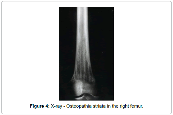 orthopedic-oncology-X-ray-Osteopathia-striata
