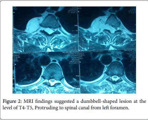 orthopedic-oncology-dumbbell-shaped