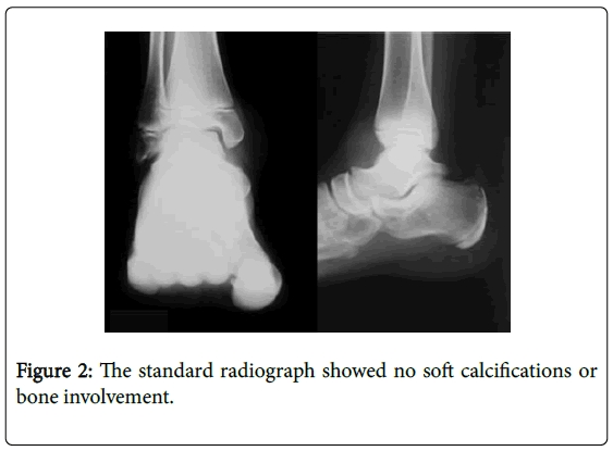 orthopedic-oncology-soft-calcifications