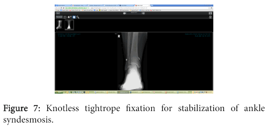 osteoarthritis-Knotless-tightrope-fixation