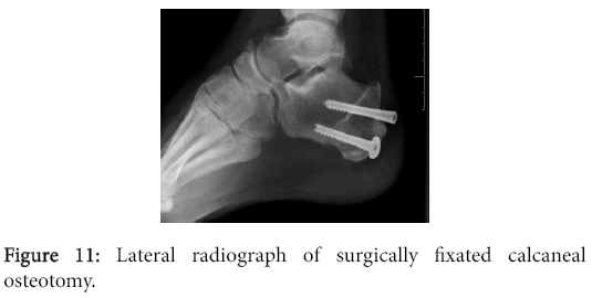 osteoarthritis-Lateral-radiograph-surgically