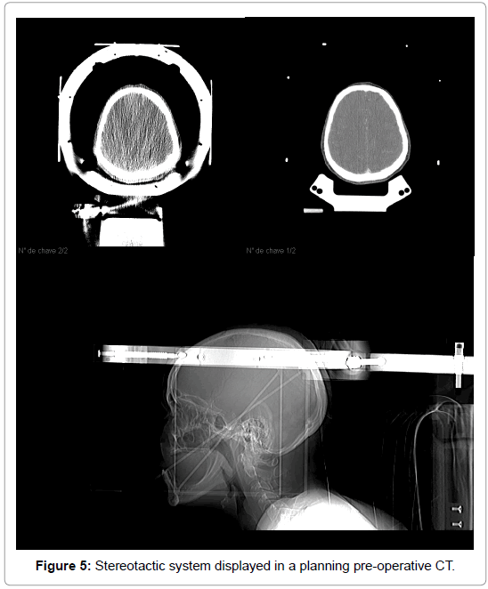 pain-relief-Stereotactic