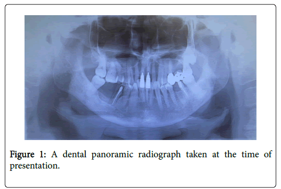 pain-relief-dental-panoramic-radiograph