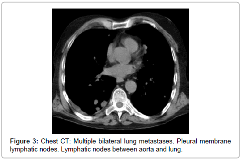 palliative-care-medicine-Chest-CT