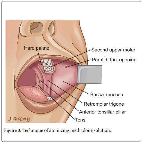 palliative-care-medicine-atomizing-methadone