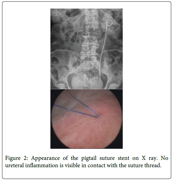 palliative-care-medicine-pigtail-suture-stent