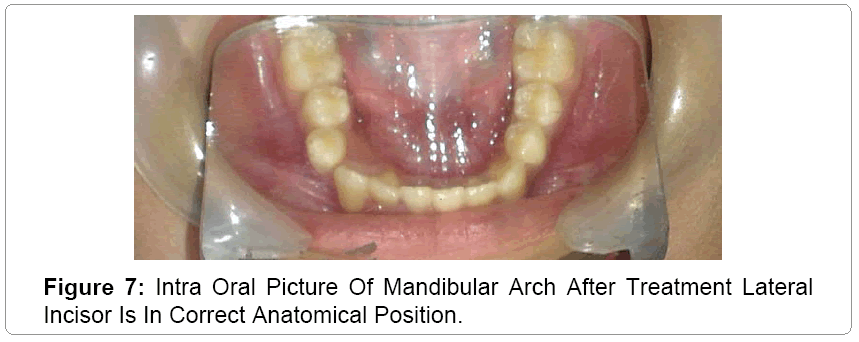 pediatric-dental-care-Incisor