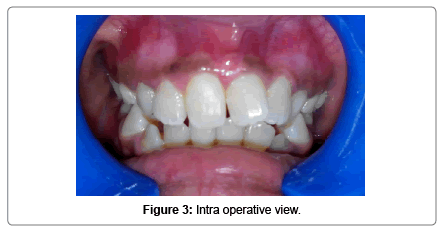 pediatric-dental-care-Intra-operative-view