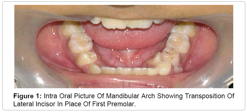 pediatric-dental-care-Mandibular