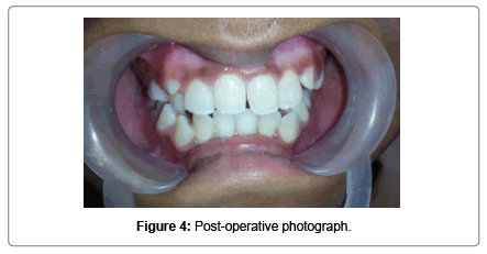 pediatric-dental-care-Post-operative-photograph