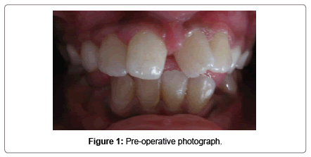 pediatric-dental-care-Pre-operative-photograph