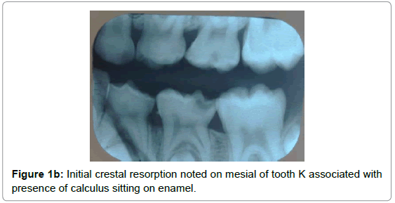 pediatric-dental-care-crestal-resorption-mesial