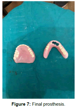 pediatric-dental-care-final-prosthesis