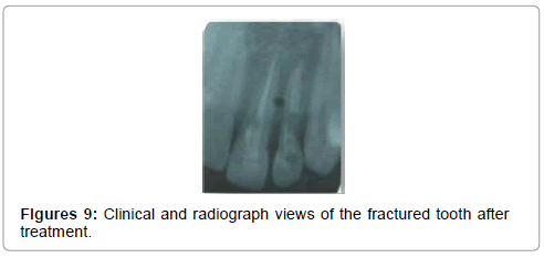 pediatric-dental-care-fractured-tooth