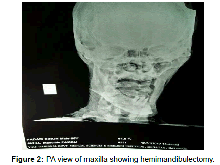 pediatric-dental-care-maxilla-hemimandibulectomy