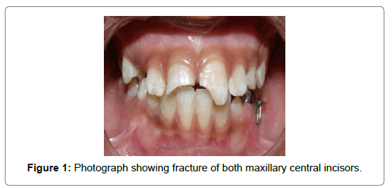 pediatric-dental-care-maxillary