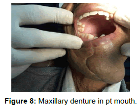 pediatric-dental-care-maxillary-denture-mouth