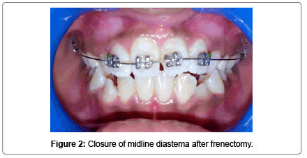pediatric-dental-care-midline-diastema-frenectomy