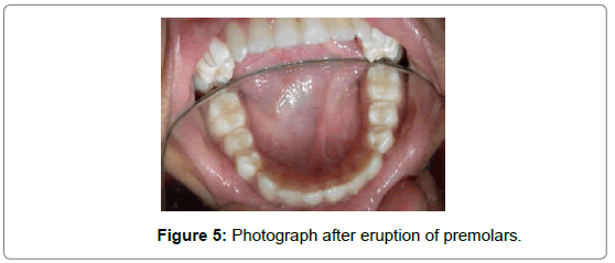 pediatric-dental-care-premolars