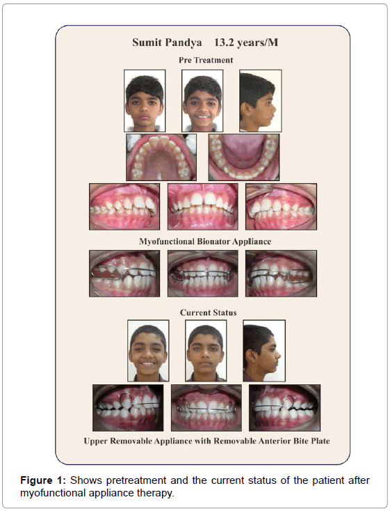 pediatric-dental-care-pretreatment-myofunctional-therapy