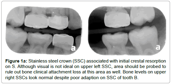 pediatric-dental-care-steel-crown-crestal