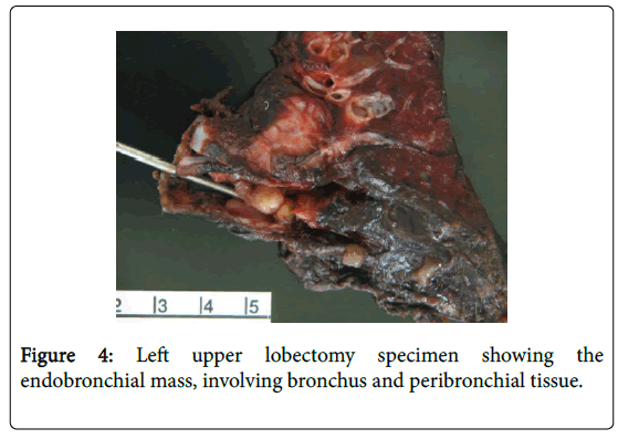 pediatric-medicine-left-upper-lobectomy