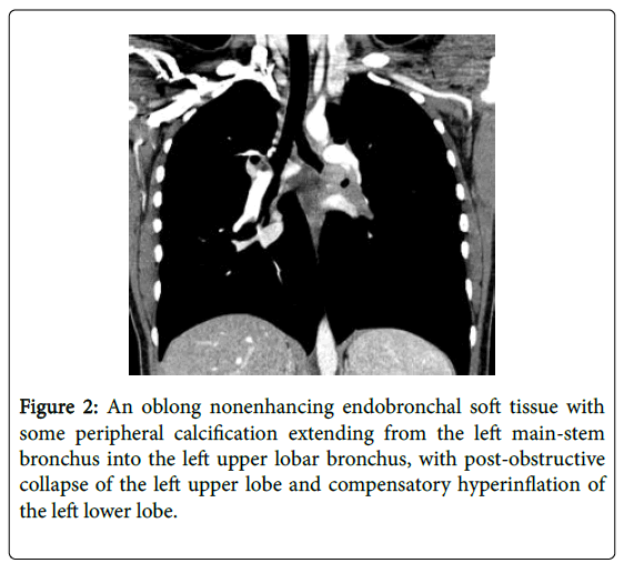 pediatric-medicine-oblong-nonenhancing-endobronchal