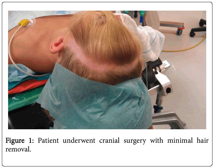 Cranial Neurosurgery without Hair  Removal  and Shampoo Care 