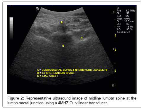 Ultrasound Guided Dextrose Prolotherapy And Platelet Rich - 