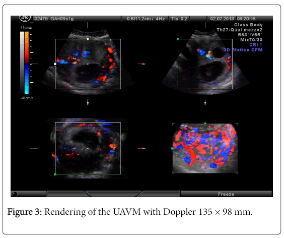 pregnancy-child-health-UAVM-Doppler