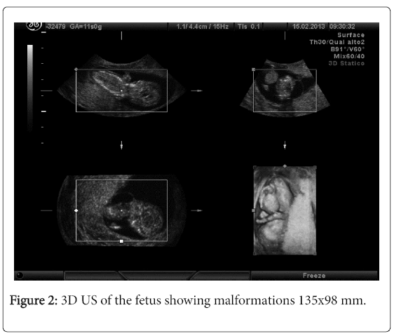 pregnancy-child-health-malformations