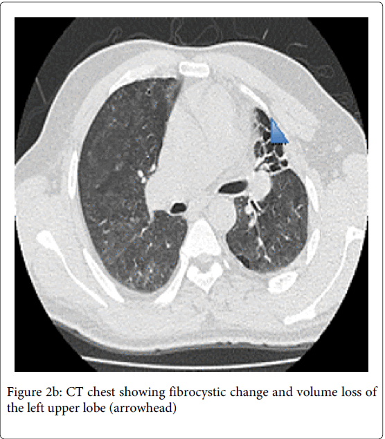 pulmonary-respiratory-medicine-upper-lobe