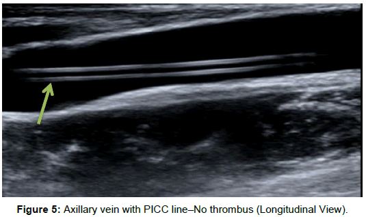 radiology-Axillary-vein