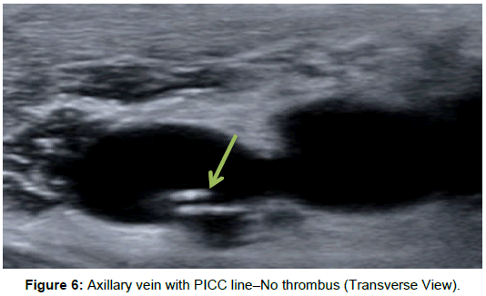 radiology-Axillary-vein-PICC