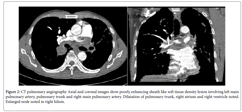 An intimal sarcoma of pulmonary artery mimicking pulmonary